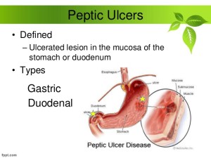 peptic-ulcer-3-638